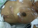 Thai phụ bị sét đánh vào ngực khi làm đồng